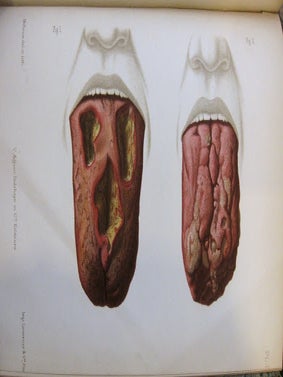 Item #YEG-1128 Des glossites tertiaires (Glossites scléreuses ; glossites gommeuses). FOURNIER...